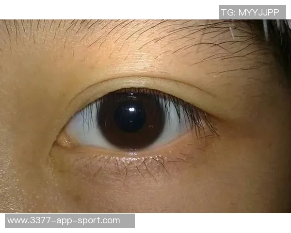 西媒揭示赫伊森眼睛难以睁开的原因是先天性眼睑下垂但不影响视力